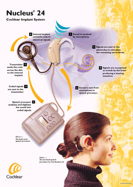 The Cochlear implant system  - click to view larger PDF document